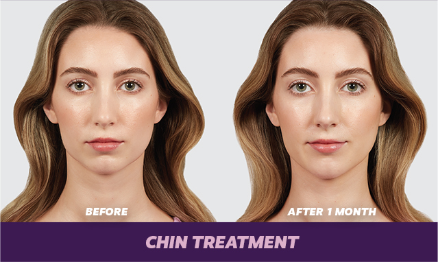 chin treatment 1